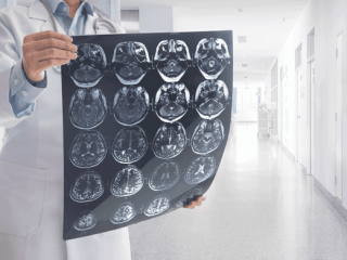 Neurochirurgas išvardijo priežastis, lemiančias hidrocefaliją