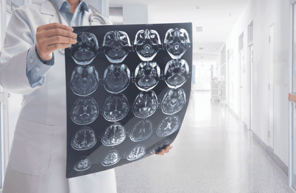 Neurochirurgas išvardijo priežastis, lemiančias hidrocefaliją