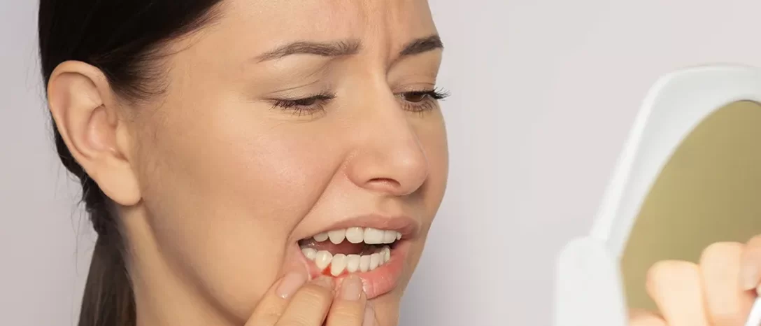 Periodontitas – kaip jį atpažinti ankstyvosiose stadijose?