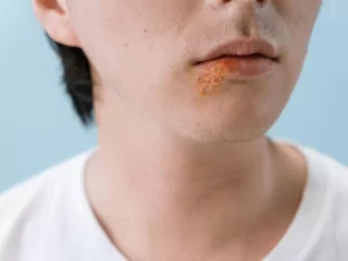 Ką svarbu žinoti apie labiausiai paplitusią virusinę infekciją – pūslelinę?
