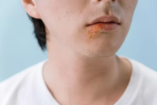 Ką svarbu žinoti apie labiausiai paplitusią virusinę infekciją – pūslelinę?
