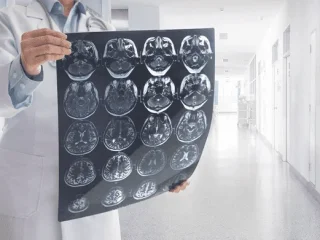Neurochirurgas išvardijo priežastis, lemiančias hidrocefaliją