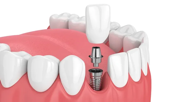 Dantų implantacija: kaip keli vizitai gali padėti susigrąžinti visavertę šypseną?